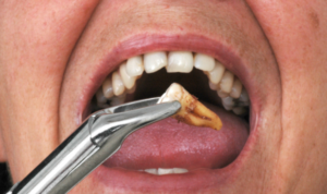 Wisdom Teeth Recovery Timeline