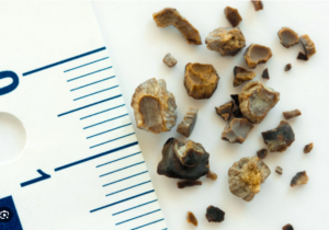 3mm Kidney Stone: Passage Time, Pain Relief & Prevention