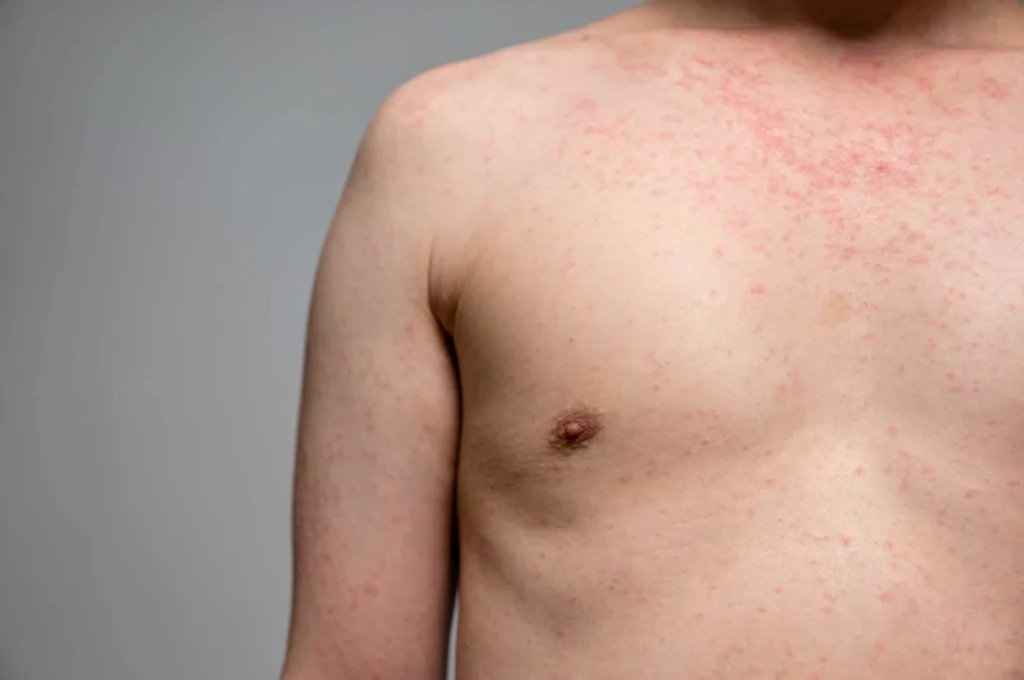 Measles vs Chickenpox: Symptoms, Differences & Care Guide