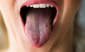 Black Spots on Tongue: Causes, Relief & When to Worry