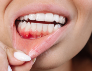 Bump in Mouth: Causes, Relief & When to See a Doctor