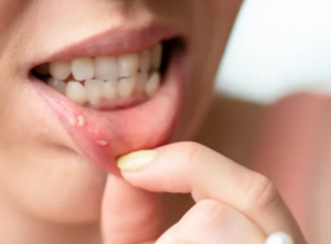 Bump on Lip: Causes, Relief & When to See a Doctor