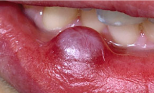 Bump on Lip: Causes, Relief & When to See a Doctor