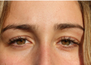 Negative Canthal Tilt: Causes, Options & Expert Guide