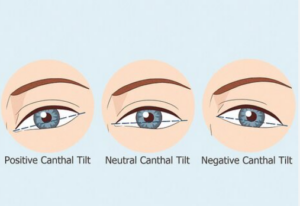 Negative Canthal Tilt: Causes, Options & Expert Guide
