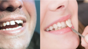 How Much Is Composite Bonding? Cost Guide & Tips